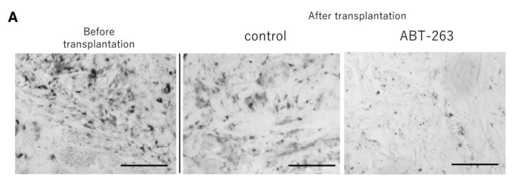 Navitoclas reduces senescent cells