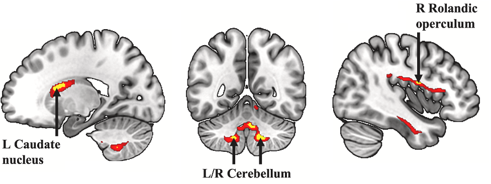 operculum brain of the l