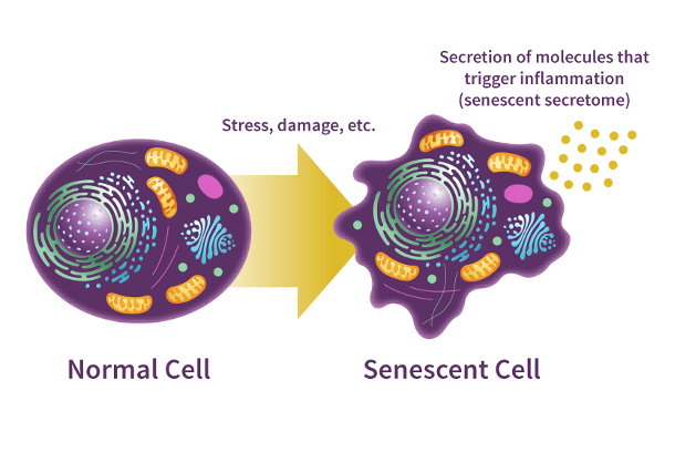 Senescent Cells and Inflammation. The diagram depicts the transformation of normal cells into senescent cells as a response to stress or damage. Senescent cells release molecules that foster inflammation, potentially contributing to age-related diseases.