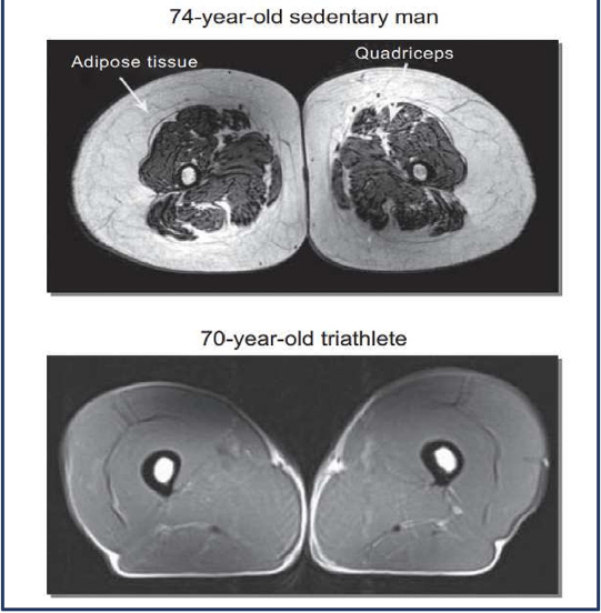 Comparison of Thigh Muscle Mass in Older Sedentary Man and Triathlete. The visual illustrates a contrast between the thigh muscle of an older sedentary man, which exhibits increased fat (adipose, white) tissue within and around the quadricep muscle (gray), and a triathlete who engages in regular intensive training (4 to 5 times per week), resulting in reduced adipose tissue and a healthier muscle composition.