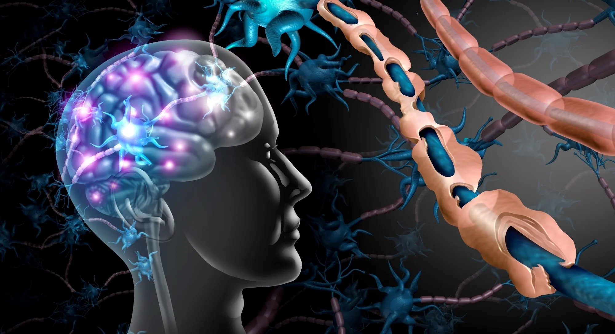 A picture showing myelin that's not working well anymore. Myelin helps brain signals go fast, but in this picture, it's not doing its job right. Picture from News-medical.net.