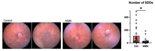 NMN treatment more than cuts in half the numbers of subretinal drusenoid deposits (SDDs) in an age-related macular degeneration mouse model.