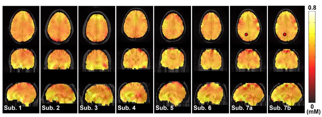 A series of brain scans that look pixelated and orange. 