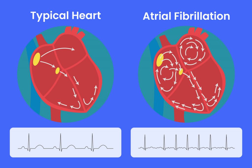 An image of a typical heart and an atrial fibrillation heart with yellow arrows pointing in the direction of electrical flow.