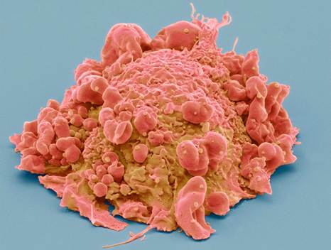 A cancer cell