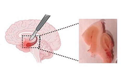 an image of a removed hippocampus.